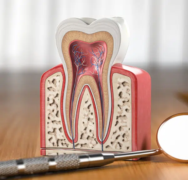 Root canal therapy in Roseville