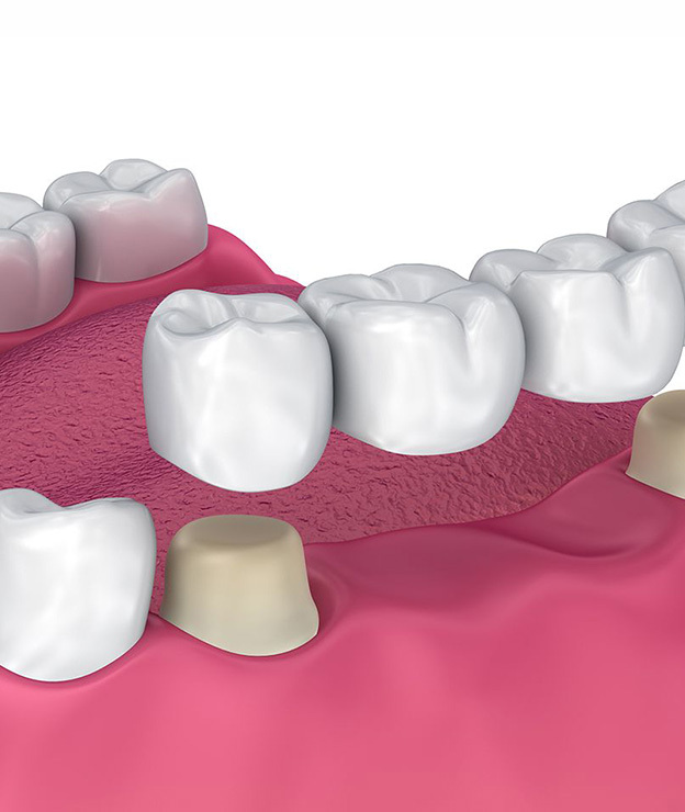 Dental Bridges in Roseville