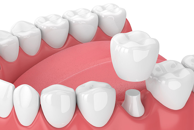 Same day crowns in Roseville