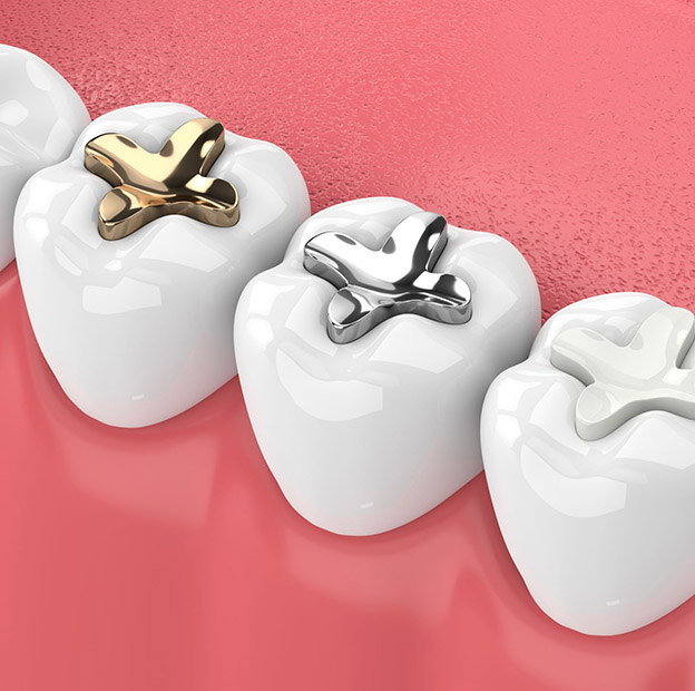 Tooth colored fillings in Roseville